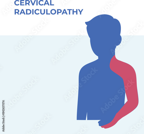 Vector illustration showing pain distribution areas associated with cervical radiculopathy, highlighting neck, shoulder and arm regions. Simplified medical graphic suitable for patient education, phys