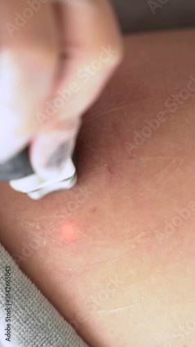 Close-up shot of Removal of blood vessels with a laser. Removal of red spots, rosacea, blood vessels, on the leg of a Caucasian woman. 4k video. Laser removal of blood vessels in modern clinic.