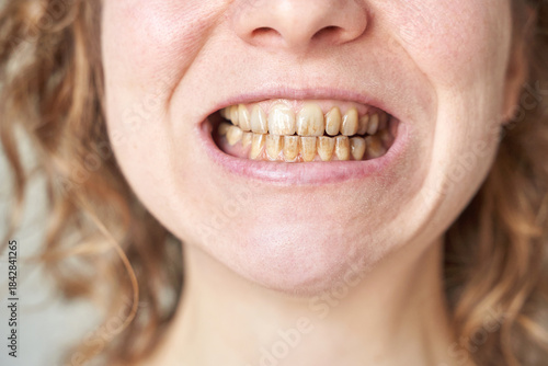 Female Caucasian adult teeth with plaque and tartar close up dental hygiene problem.