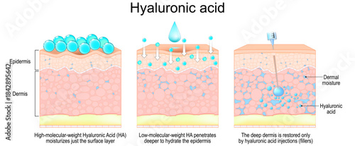 Hyaluronic acid and Dermal moisture. Skin benefits after filler injections.