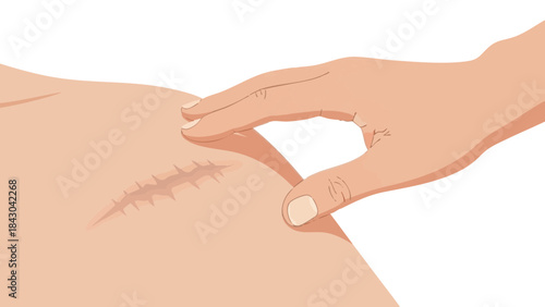 Hand touching surgical scar on human skin in concept of Medicine  