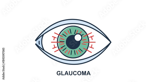 Glaucoma vector illustration showing increased intraocular pressure affecting the optic nerve and iris