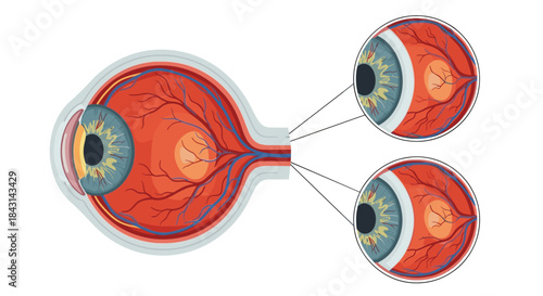 Medical diagram of the human eye anatomy in cross-section, with magnified views showing the retina, optic nerve, and blood vessels.