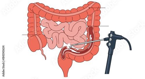 Unlabeled medical diagram of a colonoscopy procedure, with an endoscope inserted into the large intestine for examination or biopsy.