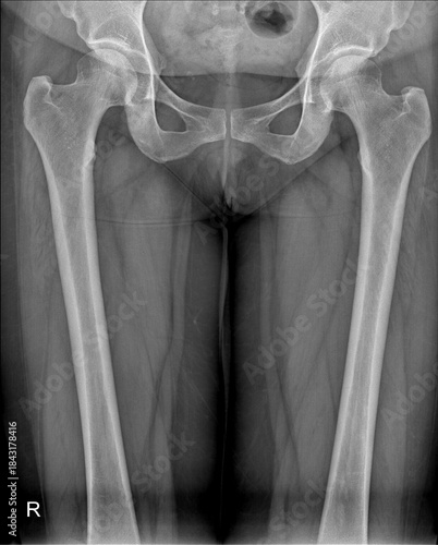 Fotografija Pelvic and Upper Leg X-ray Showing Hip Joint Alignment and Femoral Anatomy