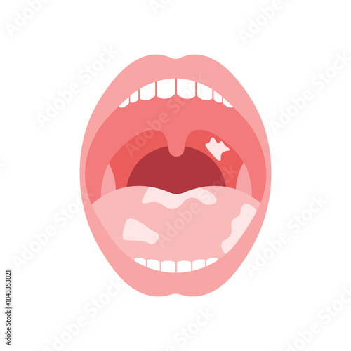 Mouth Infection Illustration