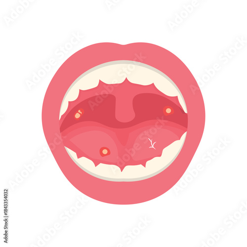 Mouth Infection Illustration