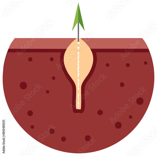 Close up medical illustration of a pore with sebum and dead skin cells being extracted