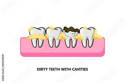 Vector illustration of cavities and dirty teeth, the impact of lack of care, suitable for dental health presentations, dental health education, or for lessons at school or hospital.