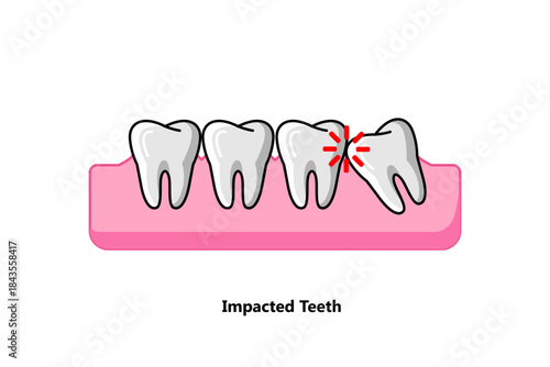 Vector illustration of impacted molar teeth, suitable for dental health presentations.