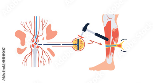 Detailed scientific illustration showing the neural pathway of the knee-jerk reflex, from the tendon stimulus to the spinal cord and muscle response.