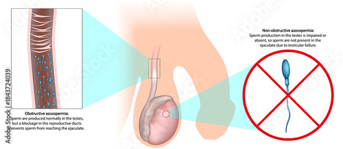 Obstructive and Nonobstructive Azoospermia Medical Illustration Comparison. Male Infertility Diagram. Azoospermia Types. Male Reproductive System Illustration