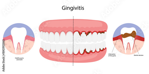 Hand-drawn dental illustration teeth affected by gingivitis. Educational medical infographic gum inflammation, redness, and early stages of periodontal disease