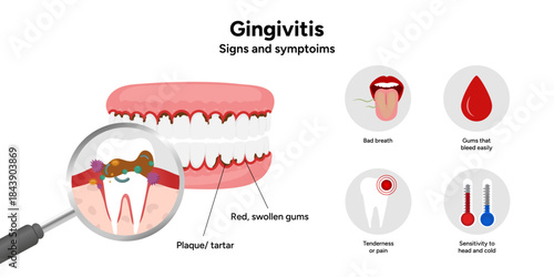Hand-drawn dental illustration teeth with gingivitis with signs and symptoms. Educational medical infographic highlighting gum redness, swelling, bleeding gums, and plaque buildup