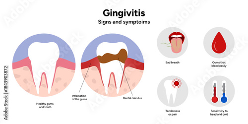 Hand-drawn dental illustration teeth with gingivitis with signs and symptoms. Educational medical infographic highlighting gum redness, swelling, bleeding gums, and plaque buildup