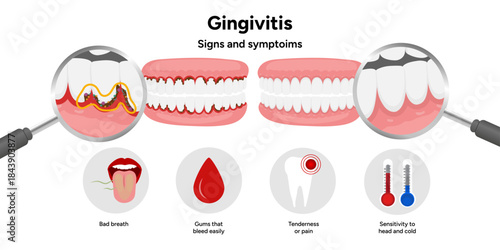 Hand-drawn dental illustration teeth with gingivitis with signs and symptoms. Educational medical infographic highlighting gum redness, swelling, bleeding gums, and plaque buildup