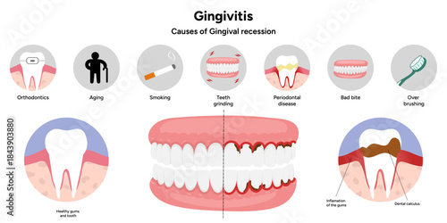 Hand-drawn dental infographic showing gingivitis and causes of gingival recession. Educational illustration explaining gum inflammation, receding gums, and periodontal problems