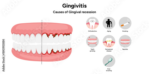 Hand-drawn dental infographic showing gingivitis and causes of gingival recession. Educational illustration explaining gum inflammation, receding gums, and periodontal problems