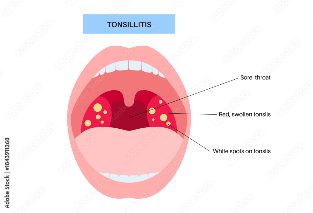 Obraz premium Tonsillitis medical poster