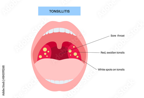 Tonsillitis medical poster