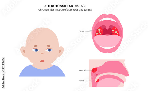 Adenotonsillar disease poster