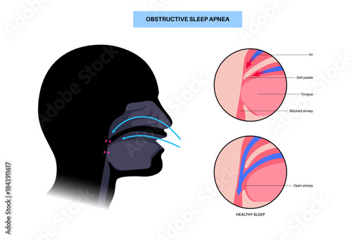 Obstructive sleep apnea