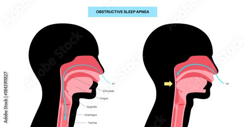 Obstructive sleep apnea