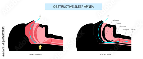 Obstructive sleep apnea