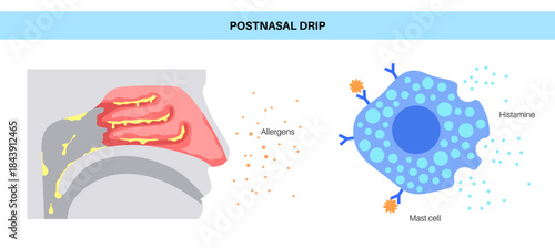 Postnasal drip poster