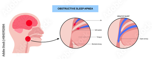 Obstructive sleep apnea