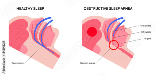 Obstructive sleep apnea