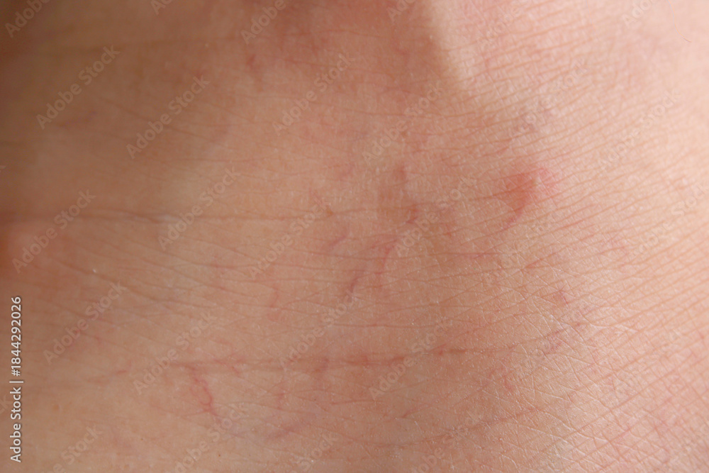 Fototapeta premium Close-up Image of Skin with Visible Stretch Marks and Textures
