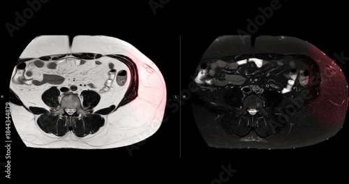 MRI whole abdomen video showing a fatty mass on the left side of the abdomen. Findings suggest a probable atypical lipomatous tumor, with differential diagnosis of well-differentiated liposarcoma. 
