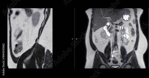 MRI whole abdomen video showing a fatty mass on the left side of the abdomen. Findings suggest a probable atypical lipomatous tumor, with differential diagnosis of well-differentiated liposarcoma. 