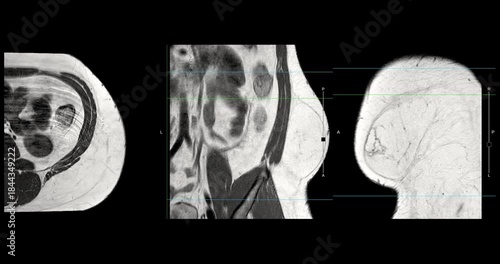 MRI whole abdomen footage showing a fatty mass on the left side of the abdomen. Findings suggest a probable atypical lipomatous tumor, with differential diagnosis of well-differentiated liposarcoma. 