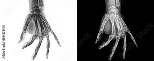 Hand Lateral Projection X-Ray Image Displaying Phalangeal and Metacarpal Bone Structure for Detection and Evaluation of Fractures Isolated on Transparent Background