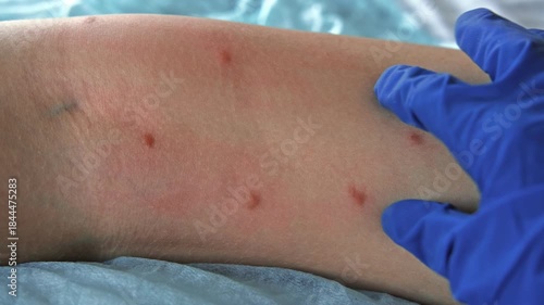 Doctor examining teen girl with bodily red rash. Allergy closeup. Teenager scratches eruption. Nurse applies special cream to atopic skin. Dermatitis, irritation, hive. Pruritus. Mosquito, flea bites