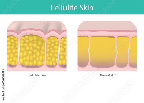 Comparison of Cellulite Skin vs Normal Skin.