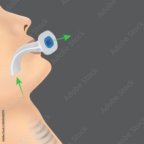 Placement of a Disposable Oral Airway