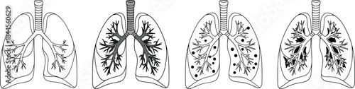 Human lungs illustration showing healthy and diseased conditions with detailed bronchial structure and medical anatomy comparison for education and healthcare design