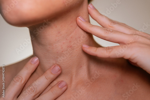 Young woman demonstrates the skin on her neck with acne and irritation. Natural skin texture, dermatology and skincare concept, beauty imperfection, sensitive skin, real body detail, cosmetic care