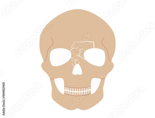 Nasal fracture poster