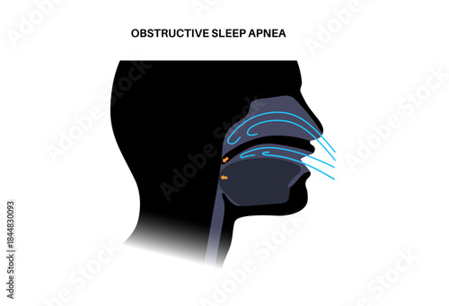 Obstructive sleep apnea