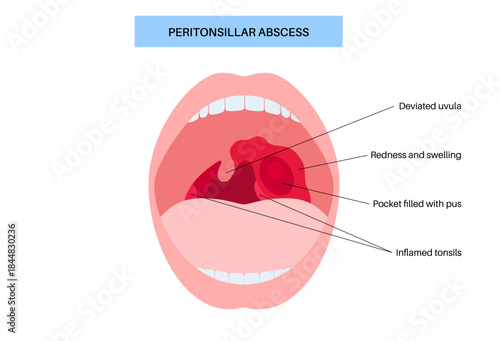 Peritonsillar abscess poster