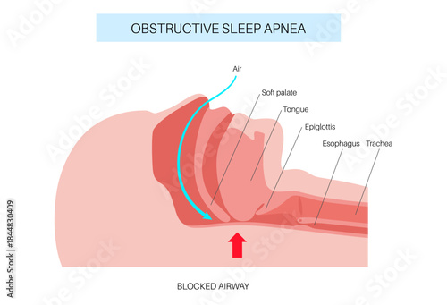 Obstructive sleep apnea