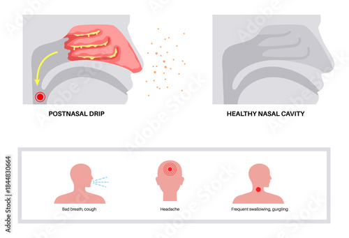 Postnasal drip poster
