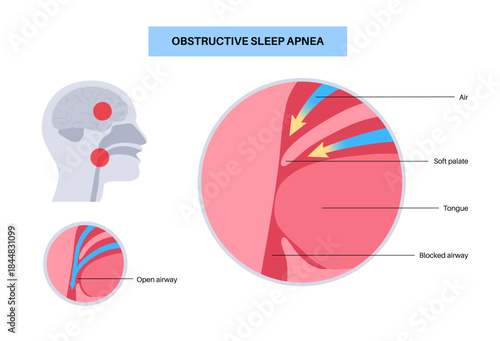 Obstructive sleep apnea