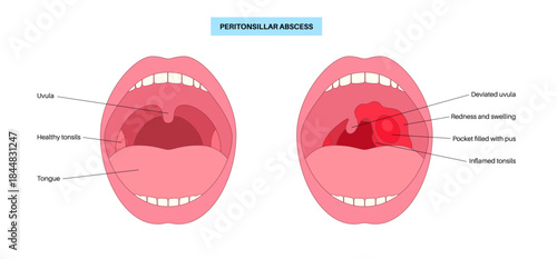 Peritonsillar abscess poster