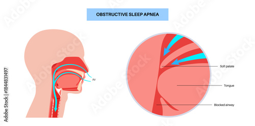 Obstructive sleep apnea