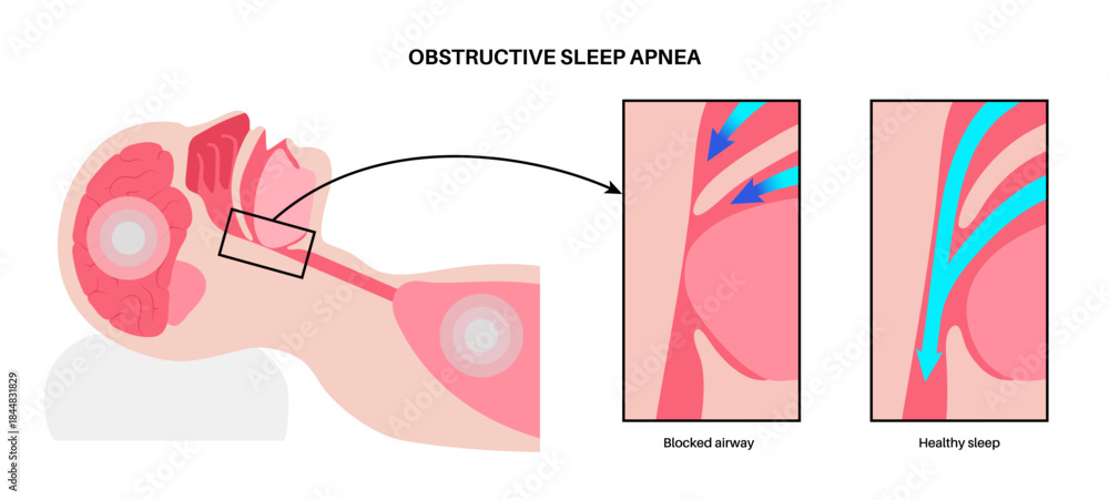 Photography Obstructive sleep apnea